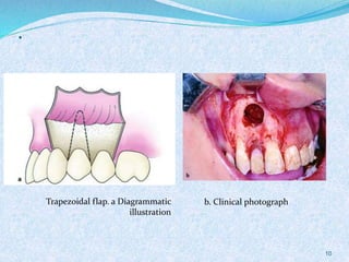 .
Trapezoidal flap. a Diagrammatic
illustration
b. Clinical photograph
10
 