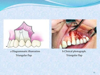 Triangular flap
a Diagrammatic illustration b Clinical photograph.
Triangular flap
13
 