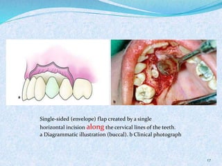 Single-sided (envelope) flap created by a single
horizontal incision along the cervical lines of the teeth.
a Diagrammatic illustration (buccal). b Clinical photograph
17
 
