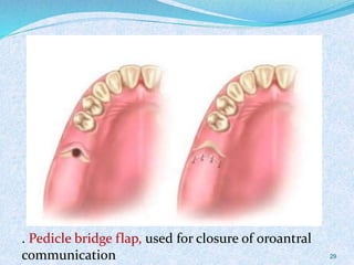 . Pedicle bridge flap, used for closure of oroantral
communication 29
 
