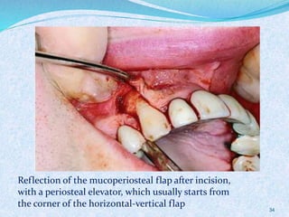 34
Reflection of the mucoperiosteal flap after incision,
with a periosteal elevator, which usually starts from
the corner of the horizontal-vertical flap
 