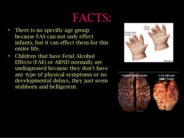 Fetal Alcohol Syndrome