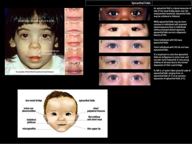 Fetal Alcohol Syndrome