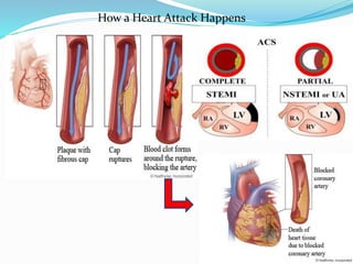 How a Heart Attack Happens
 