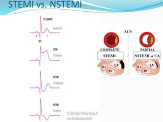 STEMI vs. NSTEMI
 