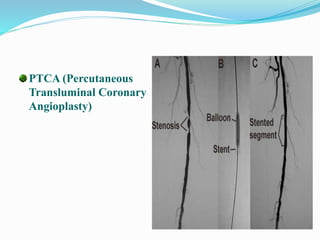 PTCA (Percutaneous
Transluminal Coronary
Angioplasty)
 