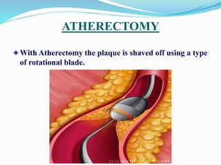 ATHERECTOMY
With Atherectomy the plaque is shaved off using a type
of rotational blade.
 