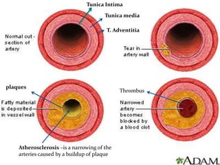 Tunica Intima
T. Adventitia
Tunica media
plaques
Thrombus
Atherosclerosis –is a narrowing of the
arteries caused by a buildup of plaque
 