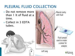  Do not remove more
than 1 lt of fluid at a
time.
 Collect in 3 EDTA
tubes.
34
 