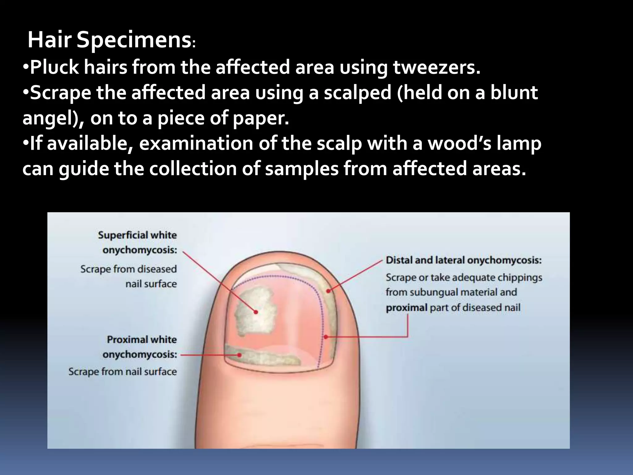Hair Specimens:
•Pluck hairs from the affected area using tweezers.
•Scrape the affected area using a scalped (held on a blunt
angel), on to a piece of paper.
•If available, examination of the scalp with a wood’s lamp
can guide the collection of samples from affected areas.
 