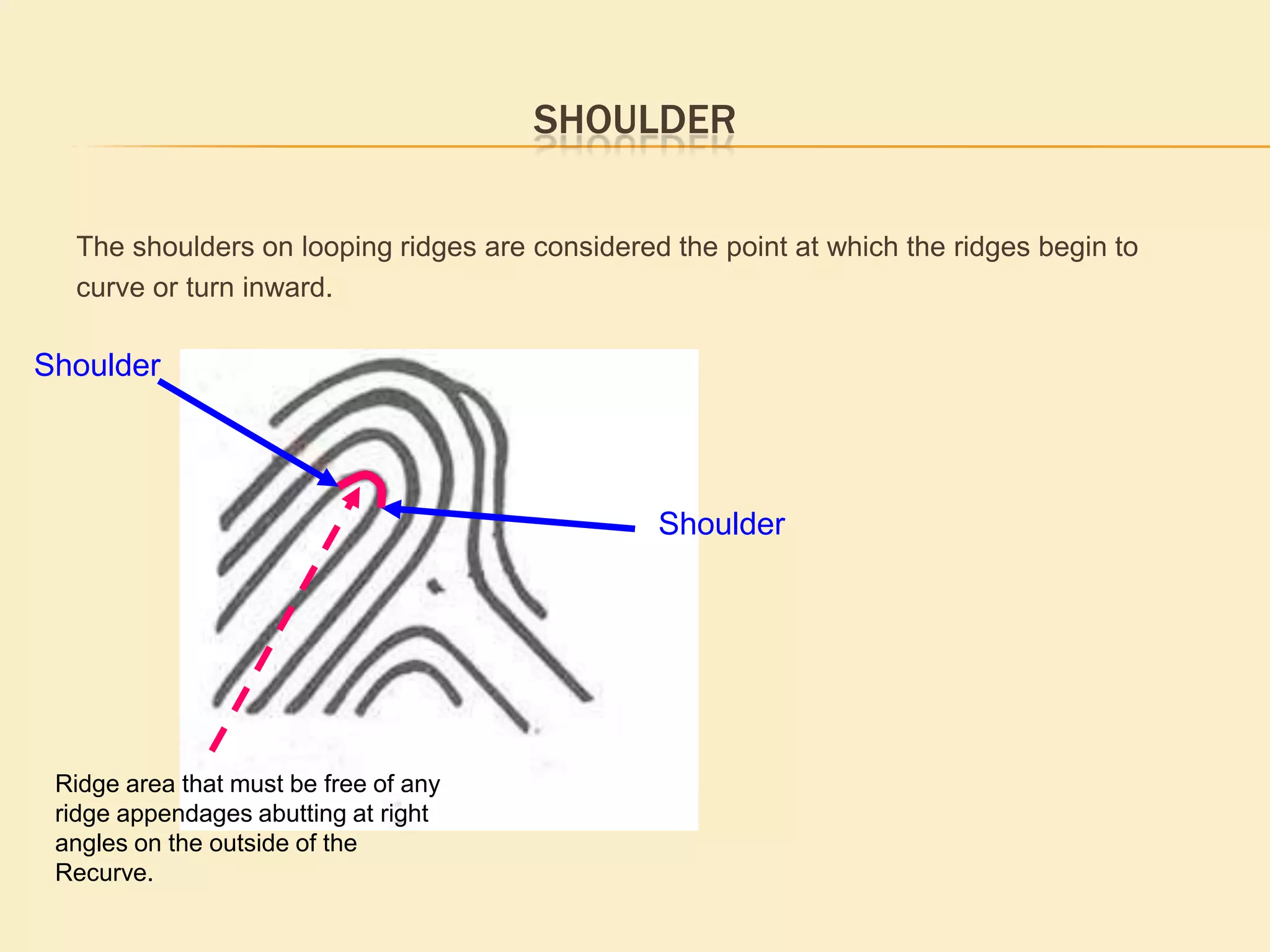 Type lines are not always continuous ridgesType lines are not may not always two continuous ridges, in fact most typelines are not continuous ridges. The causes of the breaks could be natural, damage to the finger or just a poorly captured fingerprint images. Most typelines will  have  slight ridge breaks, bifurcating ridges or the ridge will end abruptly. When there is a definite break in a type line, the ridge immediately outside of the break is considered the continuation of the ridge. If the type line bifurcates, take the ridge that tends toward the middle of the pattern area as the continuation of the type line.