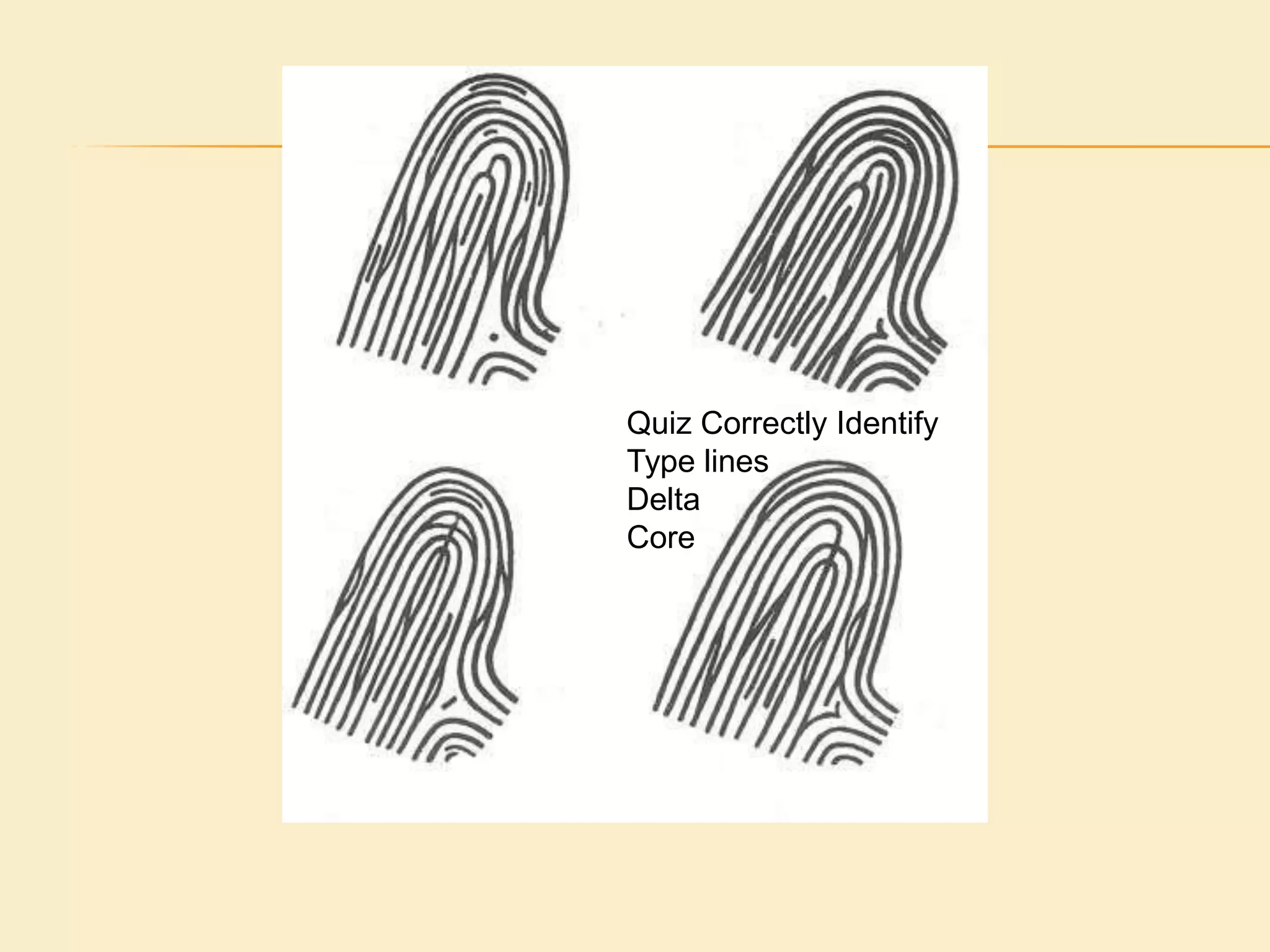 Type linesThe rule for a type line is it must run parallel, a type lines can be very short. Care must be exercised when locating the type line.  Two forks of a bifurcation cannot be used as type lines. The exception to this rule is when the forks run parallel after bifurcating and then diverge. In such a case the two forks become the two innermost ridges required by the definition. 