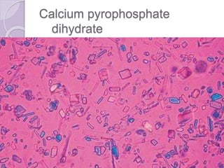 Calcium pyrophosphate
dihydrate
 