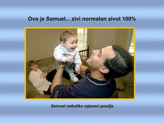 Samuel nekoliko mjeseci poslije Ovo je Samuel... zivi normalan zivot 100% 