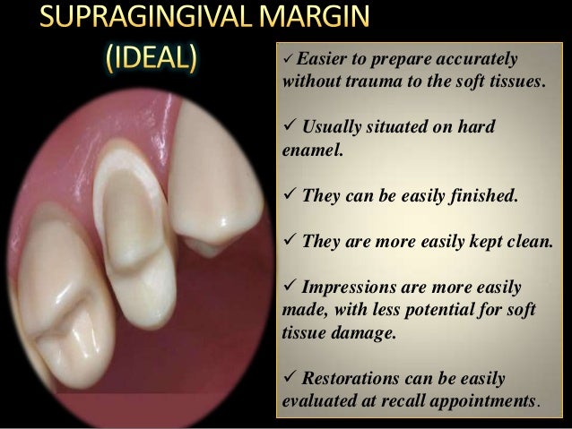 Marginal Opening Different gingival finish lines (margins) of crowns and bridges