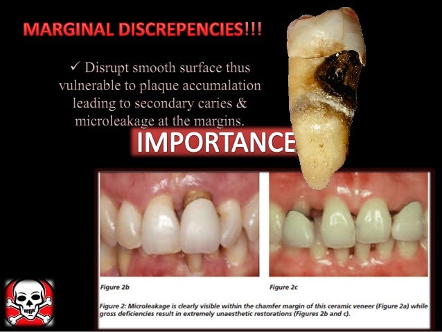 crown lengthening