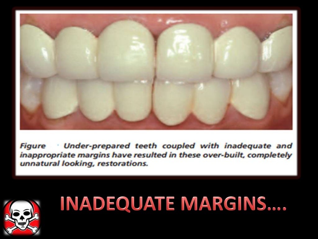 Different gingival finish lines (margins) of crowns and bridges