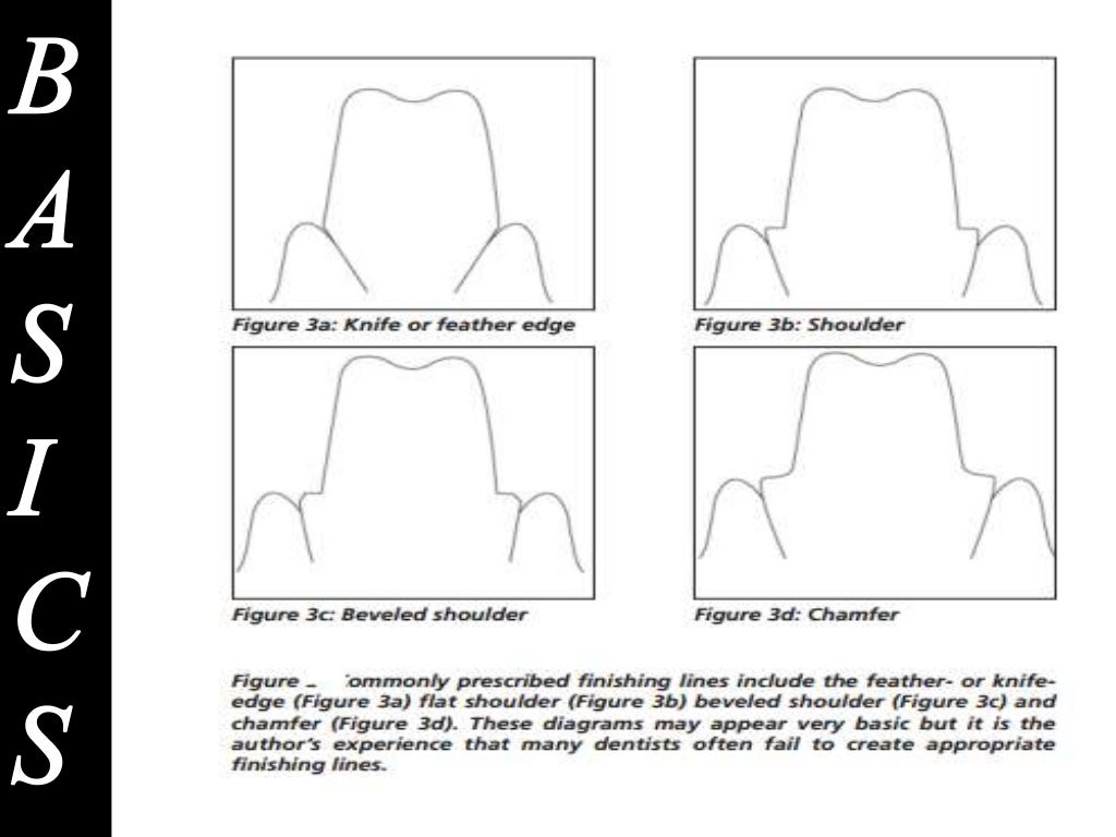 Different gingival finish lines (margins) of crowns and bridges