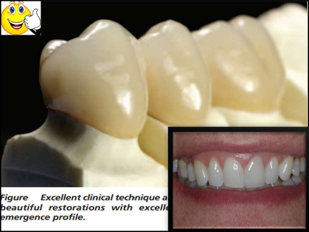 Different gingival finish lines (margins) of crowns and bridges