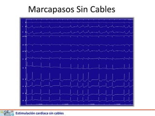 Estimulación cardiaca sin cables
Marcapasos Sin Cables
 