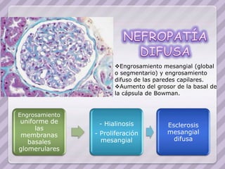 Engrosamiento mesangial (global
                      o segmentario) y engrosamiento
                      difuso de las paredes capilares.
                      Aumento del grosor de la basal de
                      la cápsula de Bowman.


Engrosamiento
uniforme de      - Hialinosis
     las                               Esclerosis
membranas       - Proliferación        mesangial
   basales        mesangial              difusa
glomerulares
 