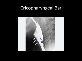 RADIOLOGY OF GIT ,RADIOLOGICAL APPROACH TO GIT .pptx