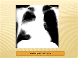 PNEUMONIA SEGMENTAR
 