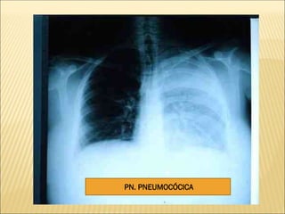 PN. PNEUMOCÓCICA
 
