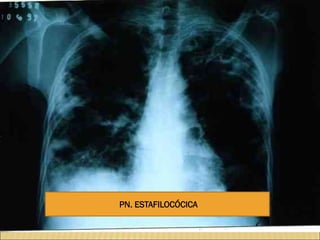 PN. ESTAFILOCÓCICA
 