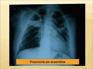 Pneumonia por anaeróbios
 