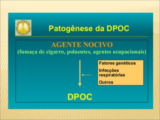 Patogênese da DPOC
AGENTE NOCIVO
(fumaça de cigarro, poluentes, agentes ocupacionais)
DPOC
Fatores genéticos
Infecções
respiratórias
Outros
 