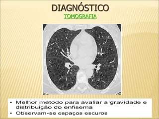 DIAGNÓSTICO
TOMOGRAFIA
 