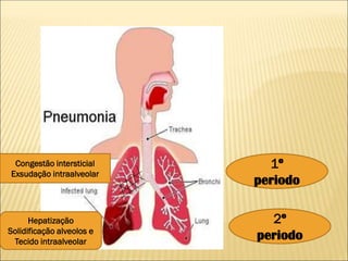Congestão intersticial
Exsudação intraalveolar
Hepatização
Solidificação alveolos e
Tecido intraalveolar
1º
periodo
2º
periodo
 