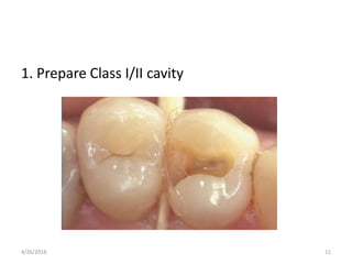1. Prepare Class I/II cavity
4/26/2016 11
 