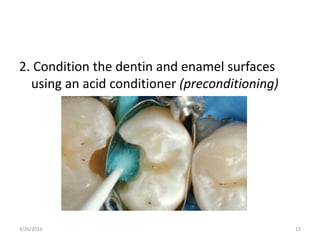 2. Condition the dentin and enamel surfaces
using an acid conditioner (preconditioning)
4/26/2016 12
 