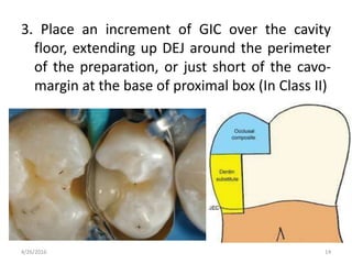 3. Place an increment of GIC over the cavity
floor, extending up DEJ around the perimeter
of the preparation, or just short of the cavo-
margin at the base of proximal box (In Class II)
4/26/2016 14
 