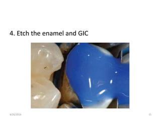 4. Etch the enamel and GIC
4/26/2016 15
 