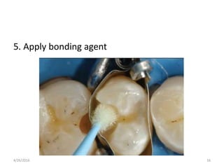 5. Apply bonding agent
4/26/2016 16
 