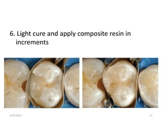 6. Light cure and apply composite resin in
increments
4/26/2016 17
 