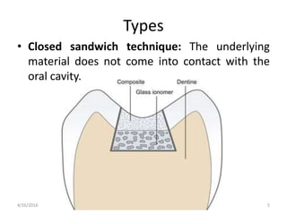 Types
• Closed sandwich technique: The underlying
material does not come into contact with the
oral cavity.
4/26/2016 5
 