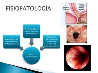 REFLUJO
GASTROESOFÁGICO
Disminución del
tono del esfínter
esofágico inferior.
Presencia de una
hernia hiatal por
deslizamiento
Retraso del
vaciamiento y
aumento del
volumen del
contenido gastrico
 