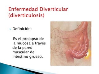  Definición:
Es el prolapso de
la mucosa a través
de la pared
muscular del
intestino grueso.
 