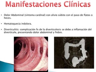 • Dolor Abdominal (síntoma cardinal) con alivio súbito con el paso de flatos o
heces.
• Hematoquecia indolora.
• Diverticulitis: complicación fx de la diverticulosis se debe a inflamación del
divertículo, presentando dolor abdominal y fiebre.
 
