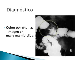  Colon por enema:
Imagen en
manzana mordida
 