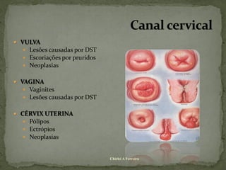  VULVA
    Lesões causadas por DST
    Escoriações por pruridos
    Neoplasias


 VAGINA
    Vaginites
    Lesões causadas por DST


 CÉRVIX UTERINA
    Pólipos
    Ectrópios
    Neoplasias


                                Chirlei A Ferreira
 