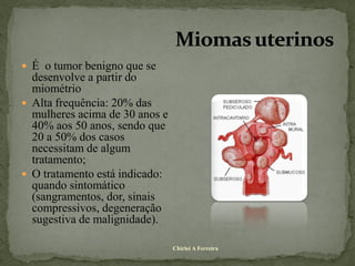  É o tumor benigno que se
  desenvolve a partir do
  miométrio
 Alta frequência: 20% das
  mulheres acima de 30 anos e
  40% aos 50 anos, sendo que
  20 a 50% dos casos
  necessitam de algum
  tratamento;
 O tratamento está indicado:
  quando sintomático
  (sangramentos, dor, sinais
  compressivos, degeneração
  sugestiva de malignidade).

                                Chirlei A Ferreira
 