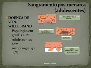  DOENÇA DE
                                             LESÃO ENDOTELIAL
                                                 NORMAL

 VON-
 WILLEBRAND
  População em         PLACA
                     PLAQUETÁRIA

   geral: 1 a 2%
                                             COÁGULO
  Adolescentes
   com
   menorragia: 5 a                                   LESÃO
                                                ENDOTELIAL VON-
   30%                                            WILLEBRAND




                        Chirlei A Ferreira
 