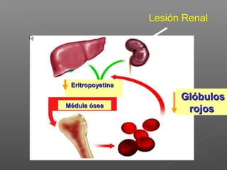 Lesión Renal




 Eritropoyetina

                        Glóbulos
Médula ósea
                         rojos
 