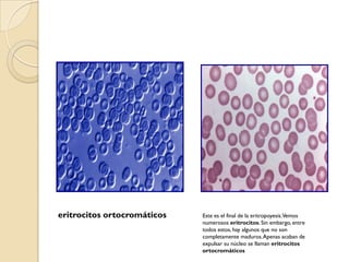 eritrocitos ortocromáticos   Este es el final de la eritropoyesis. Vemos
                             numerosos eritrocitos. Sin embargo, entre
                             todos estos, hay algunos que no son
                             completamente maduros. Apenas acaban de
                             expulsar su núcleo se llaman eritrocitos
                             ortocromáticos
 