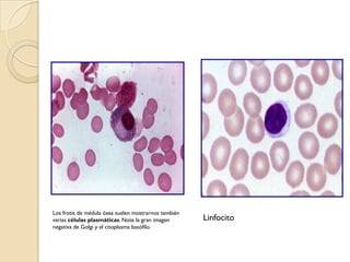 Los frotis de médula ósea suelen mostrarnos también
varias células plasmáticas. Note la gran imagen       Linfocito
negativa de Golgi y el citoplasma basófilo.
 